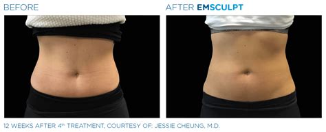 Emsculpt Los Angeles & Orange County .